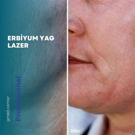  Erbiyum: Mükemmel Bir Lazer ve Manyetik Materyal mi?